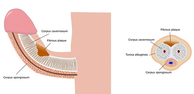 Peyronie’s Disease (Induratio Penis Plastica)